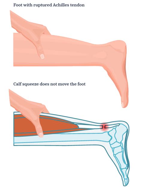 test for achilles tendon rupture